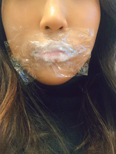 [Tiêm filler/botox] hyb - Filler môi, Botox