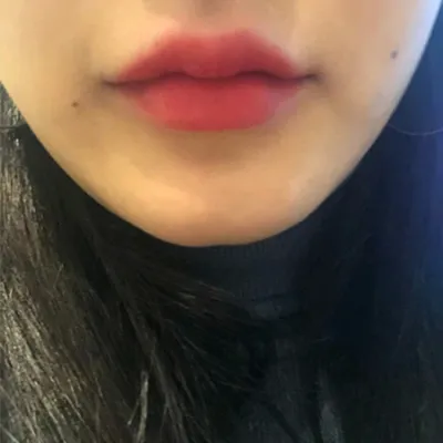 [Tiêm thẩm mỹ] hjhsjs - Botox cằm, filler