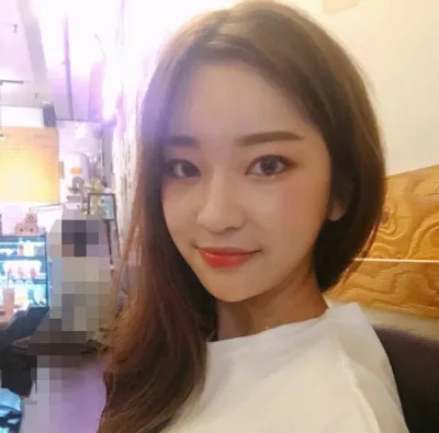 [Mắt] May123 - Mắt, Cấy mỡ