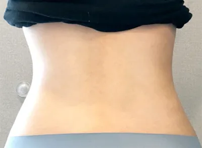 [Hút mỡ] Kkultabin - Hút mỡ bắp chân, bụng