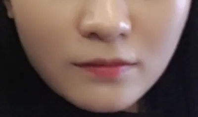 [Tiêm filler] Suvini ts - Tiêm filler môi