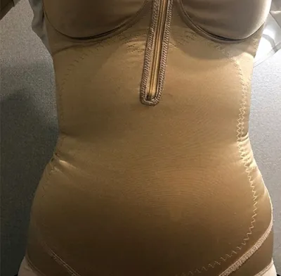 [Hút mỡ] Bay cao như ngôi sao - Hút mỡ bụng, bắp chân