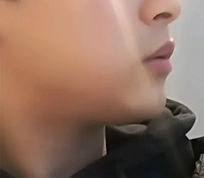 [Da] Kkkareureuk - Nâng cơ Shurink, Botox tạo đường nét