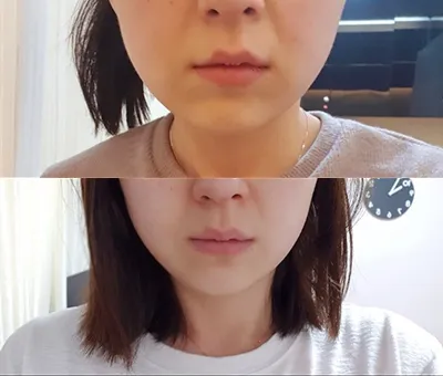 [Tiêm thẩm mỹ] deinmm - Ultherapy, Botox tạo đường nét