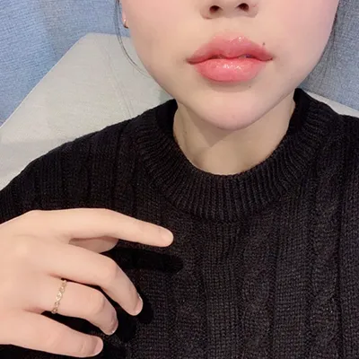 [Tiêm filler] Mọng môi - Môi