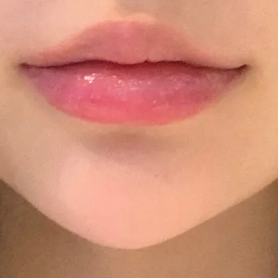 [Tiêm filler thẩm mỹ] Gya-nya-nyo-nyu - Môi, cằm