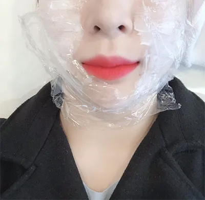 [Tiểu phẫu] 1_0A - Nâng cơ Ultherapy, Botox tạo đường nét