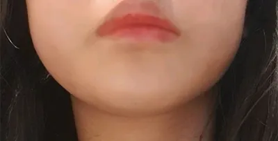 [Da] Gidan - Nâng cơ bằng laser