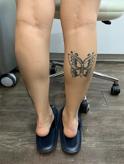 [Tiêm filler] Jenny03 - Bắp chân