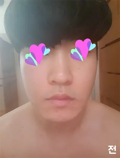 [Da] Dễ dàng thôi mà - Nâng cơ Ultherapy