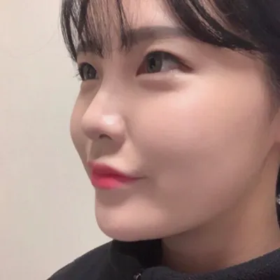 [Tiểu phẫu] Xinh đẹp tự nhiên - Mũi