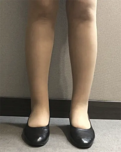 [Hút mỡ] Bay cao như ngôi sao - Bắp chân