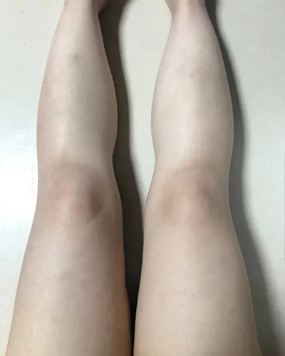 [Hút mỡ] zz0808 - Hút mỡ bắp chân, đùi