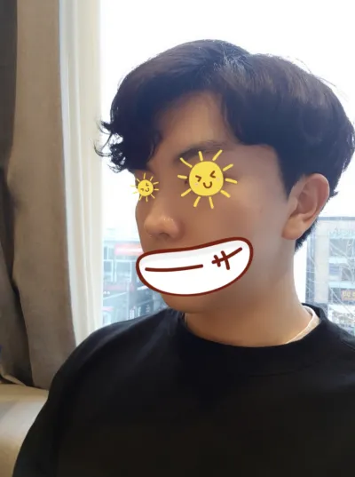 [Tiểu phẫu] Giririri - Botox thu gọn cánh mũi