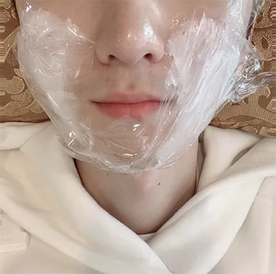 [Da] Bánh hạt dẻ nướng - Ultherapy, Tiêm tan mỡ