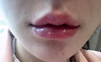 [Tiểu phẫu] Ếch tập bơi - Môi