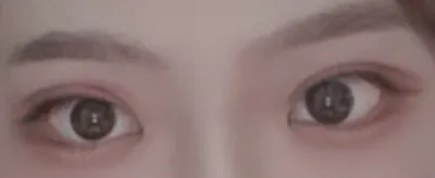 [Mắt] Bệnh viện B - Cắt mí