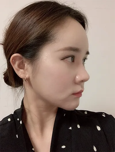 [Tiêm Filler/Botox] kiya*** - Nâng cơ