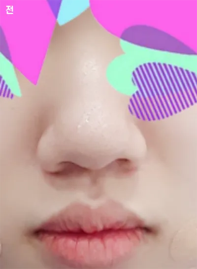 [Tiểu phẫu] Wasabim - Mũi