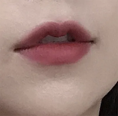 [Tiêm filler] amy13 - Tiêm filler môi