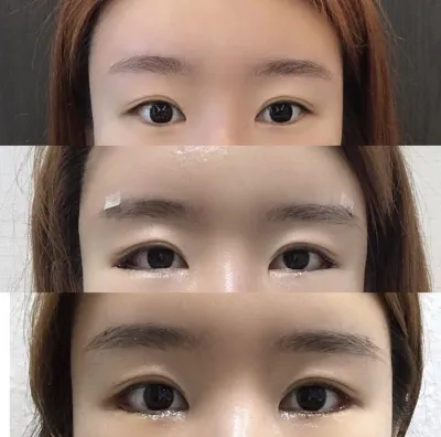 [Mắt] Nanani Nan - Mở rộng góc mắt ngoài, Hạ góc mắt dưới