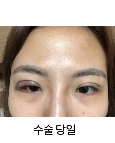 [Mắt] Sree8536 - Chỉnh sửa mí mắt