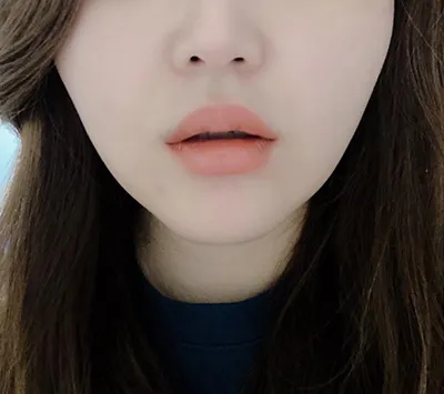 [Tiểu phẫu] Người mới Blinii - Botox khóe miệng, filler môi