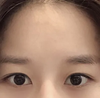 [Mắt] Shunkyun - Mở rộng góc mắt ngoài, hạ góc mắt