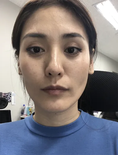 [Chống lão hóa] Namona - Cấy mỡ toàn mặt