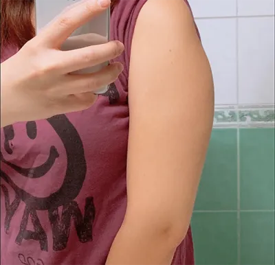 [Hút mỡ] Blueberryyong - Hút mỡ