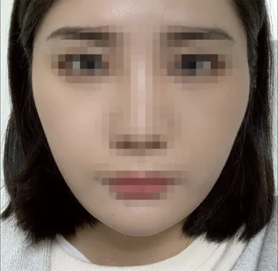 [Gọt mặt] Oinginga - Gọt mặt, mũi, cấy mỡ