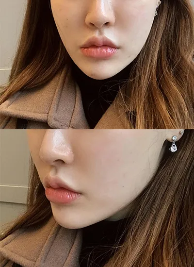 [Da] Muốn xinh đẹp hơn - Ultherapy, Botox tạo đường nét