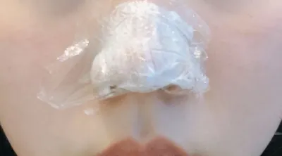 [Tiểu phẫu] Prury - Botox, Đầu mũi