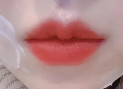 [Tiểu phẫu] hunnie8894 - Tiêm filler môi