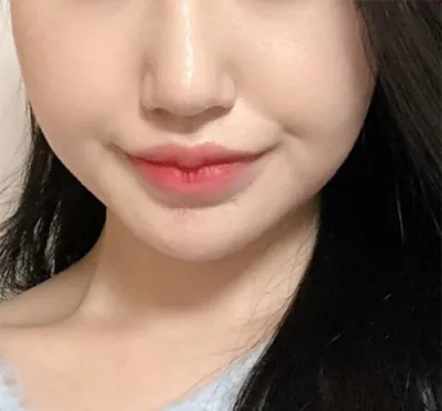 [Da] Zizi Zizi Zizi - Ultherapy, Botox tạo đường nét