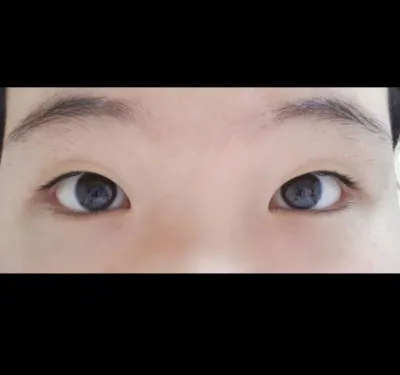 [Mắt] Sseuyun - Bấm mí, mở góc mắt trước