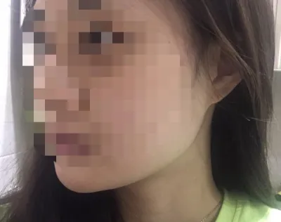 [Tiểu phẫu] Nina Nangyiing - Tiêm tan mỡ, nâng cơ