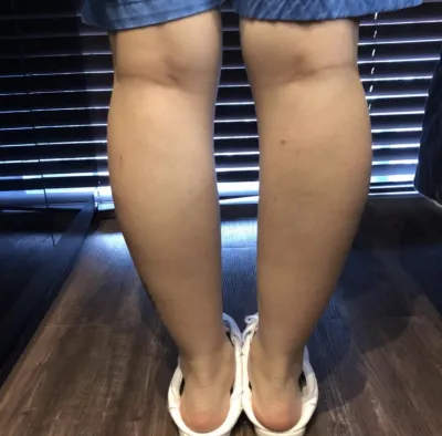 [Tiểu phẫu] Ppoonggyung - Botox, Tiêm tan mỡ