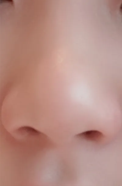 [Tiêm thẩm mỹ] 7 giờ 11 phút - Tiêm tan mỡ tạo hình mũi