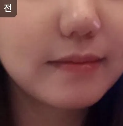 [Da] oy1004 - Nâng cơ, tiêm căng bóng