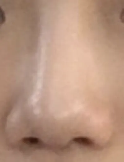 [Tiểu phẫu] dbwladl - Mũi