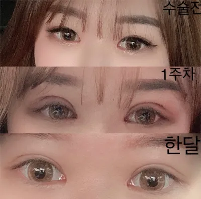 [Mắt] Rohsion - Mở góc mắt trên, chỉnh sửa mắt, tái phẫu thuật