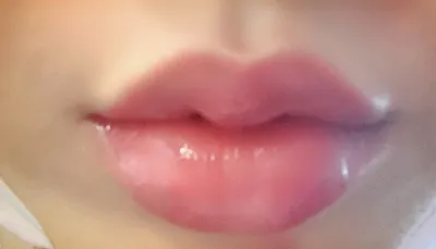 [Tiểu phẫu] Jungdeun2 - Tiêm filler môi