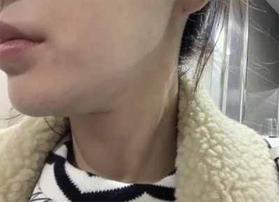 [Tiêm thẩm mỹ] Rudolph Mom - Botox, Tiêm tan mỡ