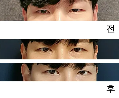 [Mắt] WDHH - Chỉnh sửa mí mắt