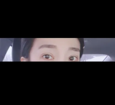 [Mắt] Half-Baff - Tái phẫu thuật mắt