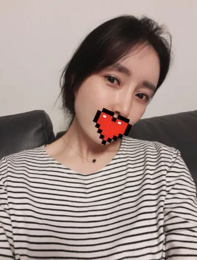 [Chống lão hóa] ㅅㄴㄷㄴㅅㅊ - Mắt, Cấy mỡ