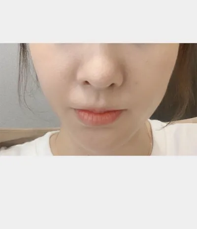 [Tiểu phẫu] 55 mũi tiêm - Nâng cơ bằng chỉ