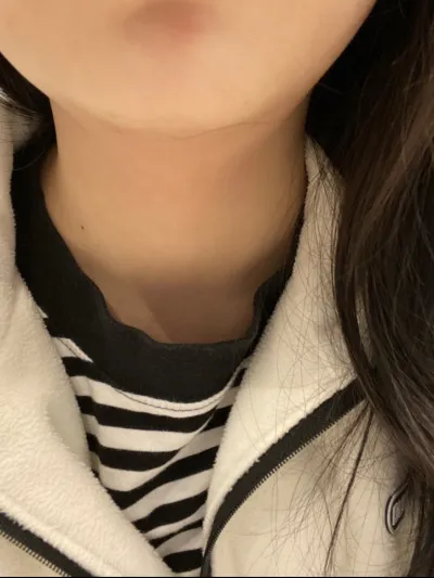 [Tiểu phẫu] Tiêm thon gọn cằm - Nâng cơ Shurink