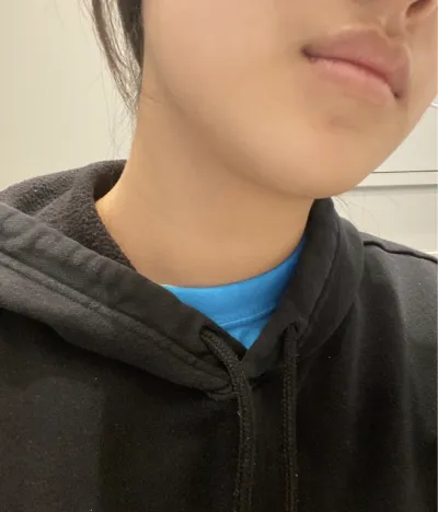 [Tiêm filler] Muimya - Tiêm tan mỡ, Ultherapy